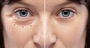 Characteristics Of Botox In Dubai