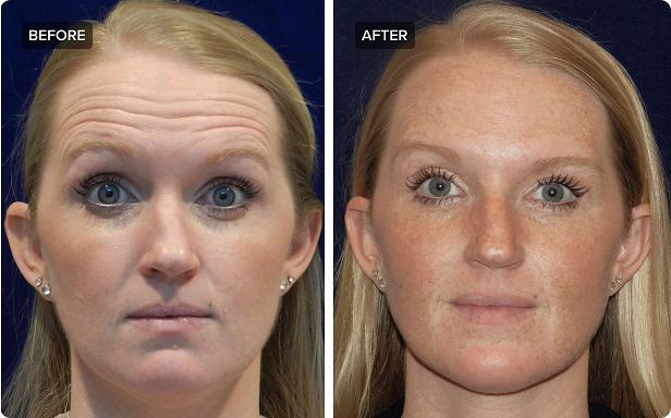 Botox for a Youthful Appearance